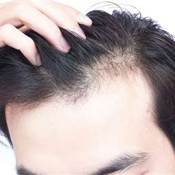 چه چیزی باعث ریزش مو استرسی می شود؟ (و راه های پیشگیری از آن)